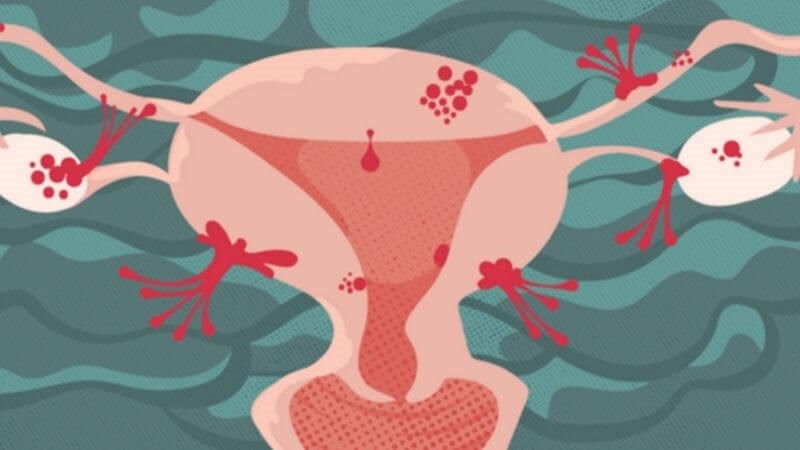 Lạc nội mạc tử cung có ảnh hưởng đến khả năng sinh sản không?
