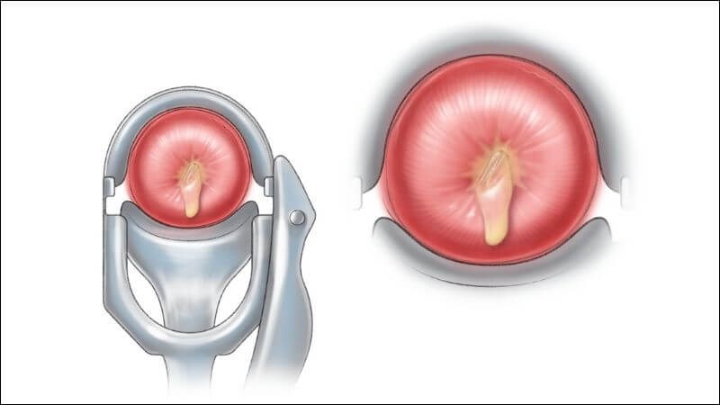 4. Tác động từ thủ thuật phụ khoa