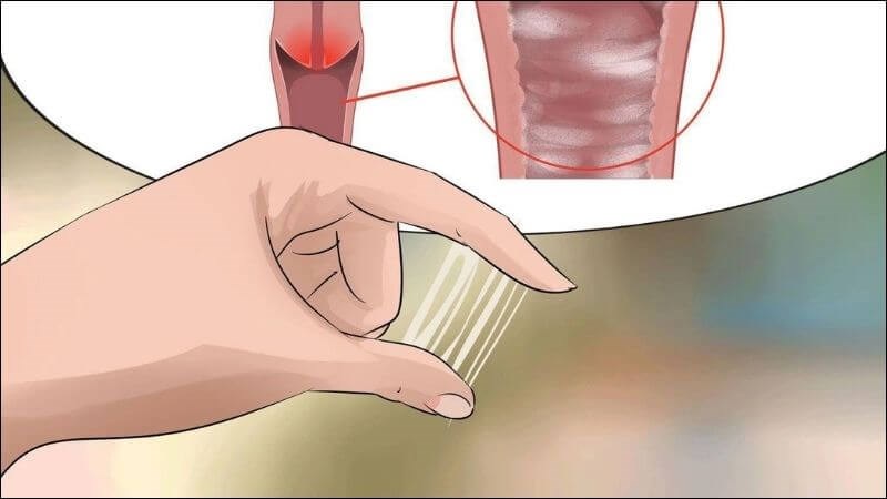 Khí hư màu vàng là dấu hiệu của viêm cổ tử cung