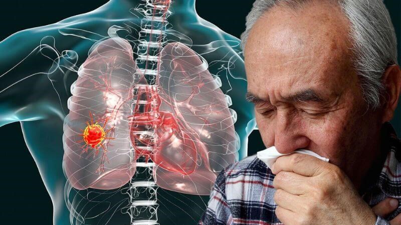 Ho khan, ho dai dẳng là một trong những triệu chứng của ung thư phổi