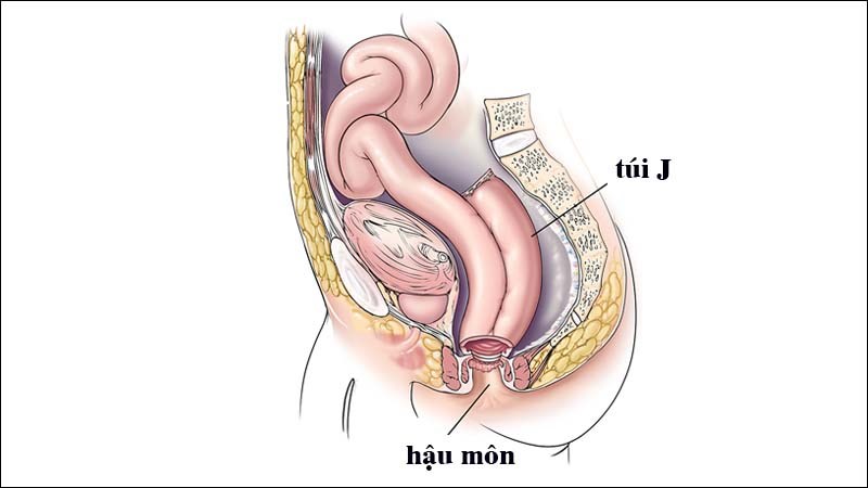 Túi J nằm bên trong cơ thể đảm bảo tính thẩm mỹ cho người bệnh.