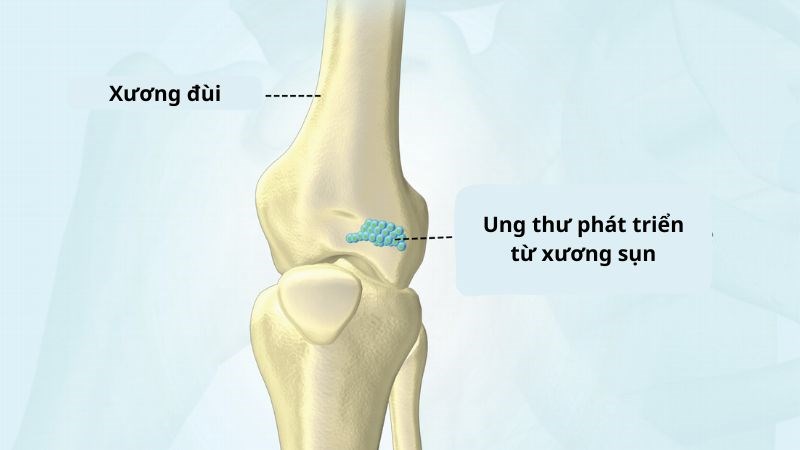 Các tế bào ung thư Sarcoma sụn có nguồn gốc từ tế bào biến đổi tạo ra sụn
