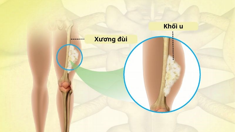 Ewing sarcoma là một loại ung thư xương thường ảnh hưởng đến trẻ em và thanh niên nhiều hơn là người lớn tuổi