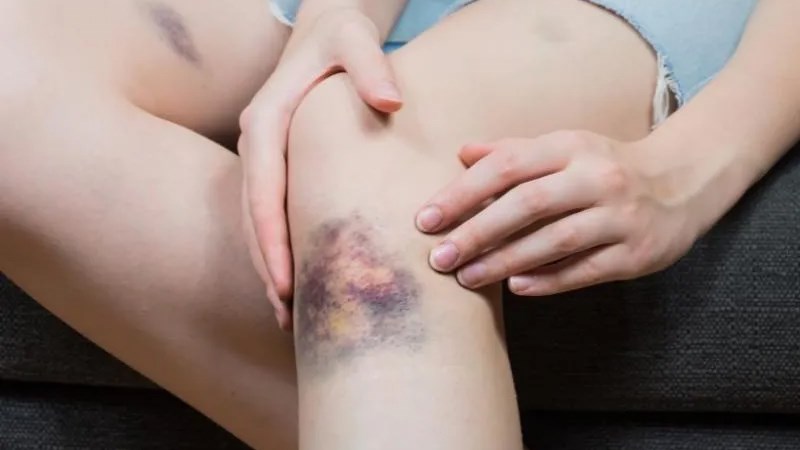 Các vết bầm tím xuất hiện trên 2 tuần mà không biến mất là dấu hiệu cảnh báo bệnh