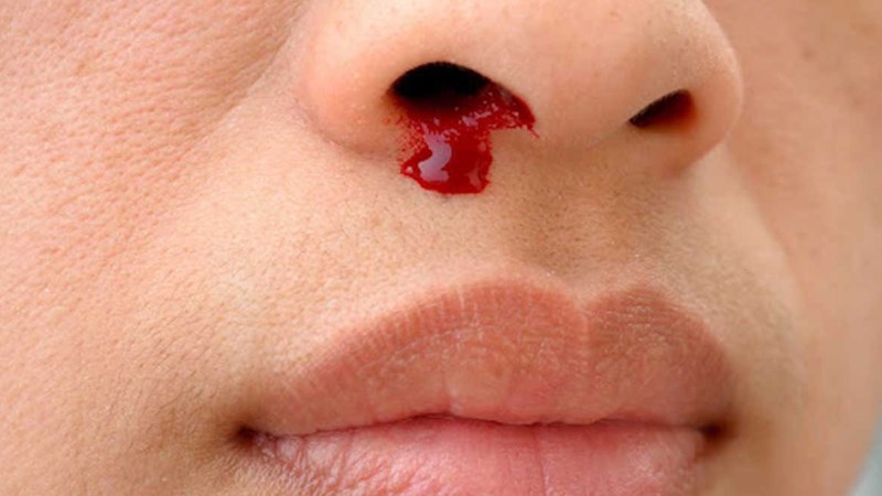 Chảy máu bất thường là biến chứng của ung thư máu