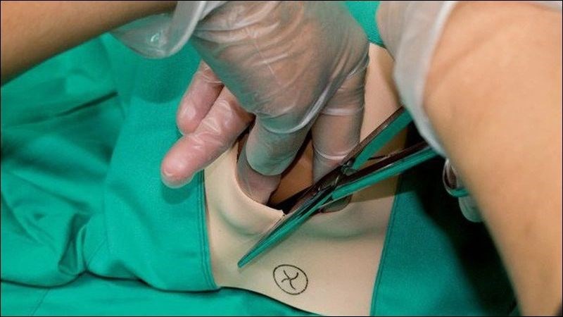 Chấn thương đường sinh dục được xem là nguyên nhân thứ 2 gây băng huyết sau sinh Chấn thương đường sinh dục được xem là nguyên nhân thứ 2 gây băng huyết sau sinh