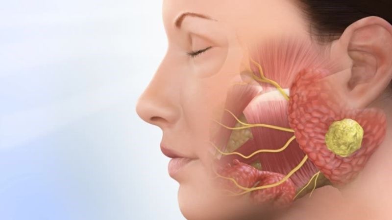 Áp lực chèn ép lên dây thần kinh số 5 gây đau do tổn thương bao myelin