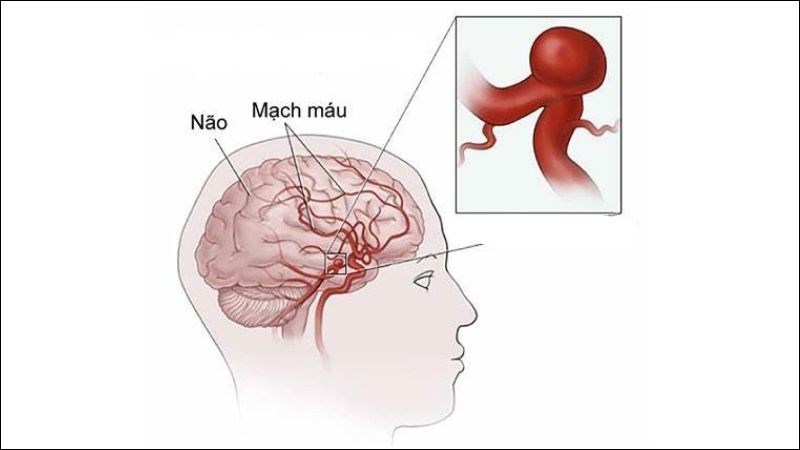 Dị dạng mạch máu tạo phình mạch chèn ép dây thần kinh