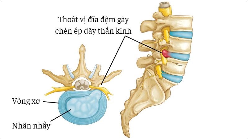 Thoát vị đĩa đệm hay gặp thoát vị vùng thắt lưng