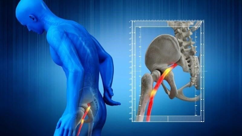 Đau thần kinh tọa biểu hiệu đau dọc từ thắt lưng xuống cẳng chân 2 bên