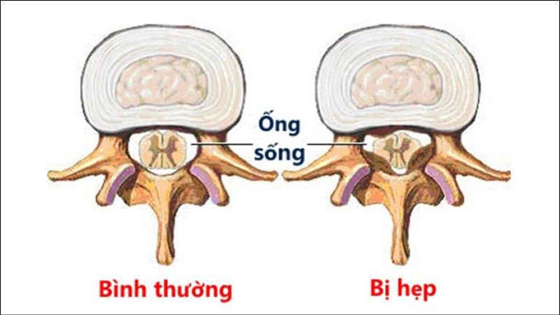 Hẹp ống sống gây chèn ép thần kinh, đau thắt lưng mạn tính