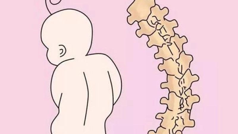 Vẹo cột sống gây đau thắt lưng