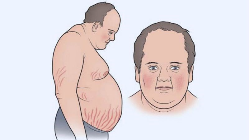 Bệnh nhân bị Cushing có thể trạng béo trung tâm