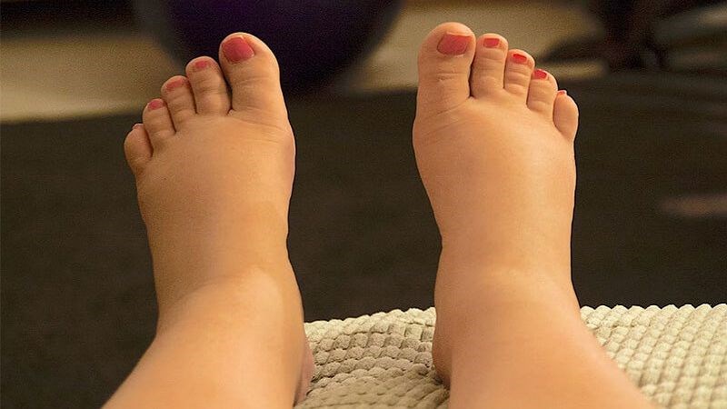 Tăng cân thường kèm theo các triệu chứng khác như rạn da, giãn mạch, phù chân...