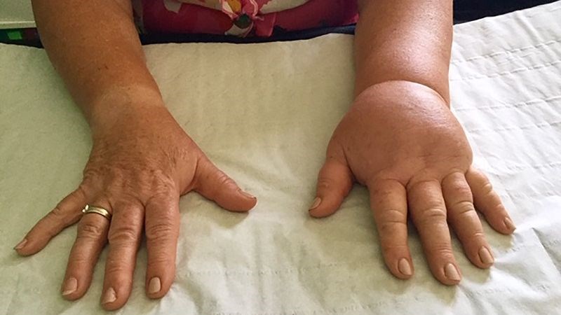 Phù bạch huyết cánh tay có thể dẫn đến sưng ngón tay