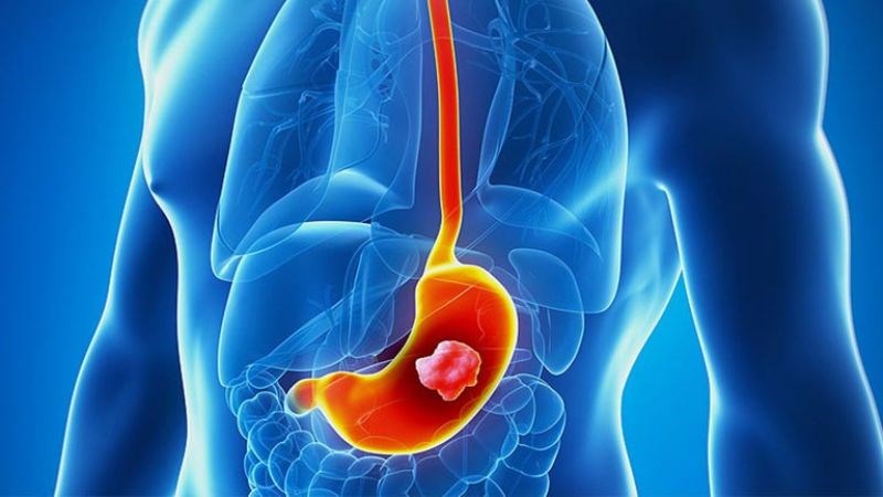 Ung thư dạ dày đứng thứ 4 trong số 5 bệnh ung thư phổ biến nhất