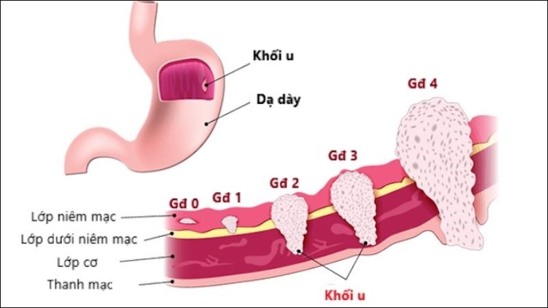 Các giai đoạn của bệnh ung thư dạ dày theo mức độ xâm lấn tế bào ung thư
