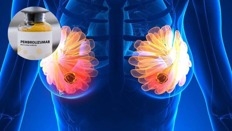 Có thể điều trị ung thư vú bằng liệu pháp miễn dịch