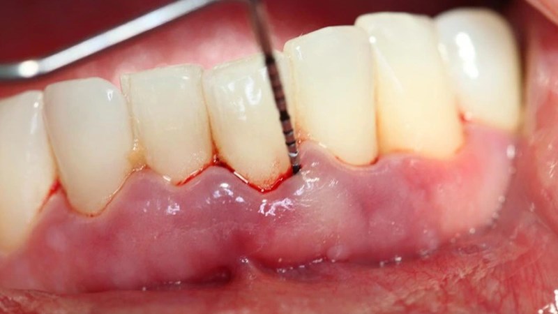 Nướu răng có thể chuyển sang màu đỏ thẫm
