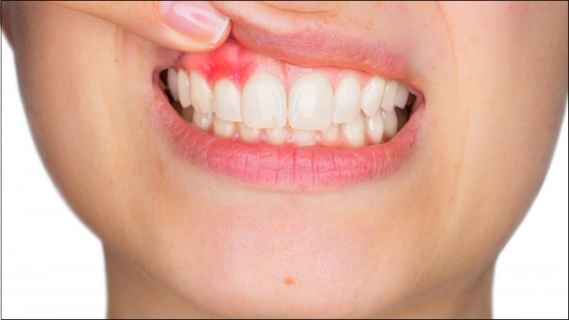 Các tổn thương tại nướu gây cảm giác đau khi chạm vào nướu