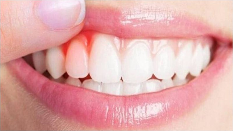 Viêm nướu kéo dài là dấu hiệu cảnh báo bệnh ung thư nướu