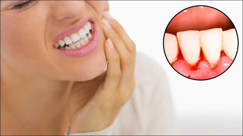 Chảy máu nướu kéo dài là dấu hiệu cảnh báo tình trạng nghiêm trọng ở nướu răng