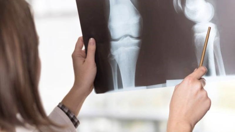 Chụp X-quang để chẩn đoán đau đầu gối