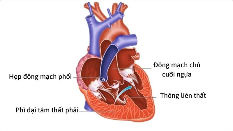 Tứ chứng Fallot là bệnh tim bẩm sinh phức tạp gồm 4 dị tật Tứ chứng Fallot là bệnh tim bẩm sinh phức tạp gồm 4 dị tật