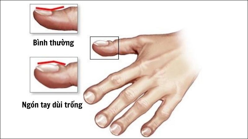 Ngón tay, ngón chân dùi trống là biểu hiện muộn của bệnh Ngón tay, ngón chân dùi trống là biểu hiện muộn của bệnh