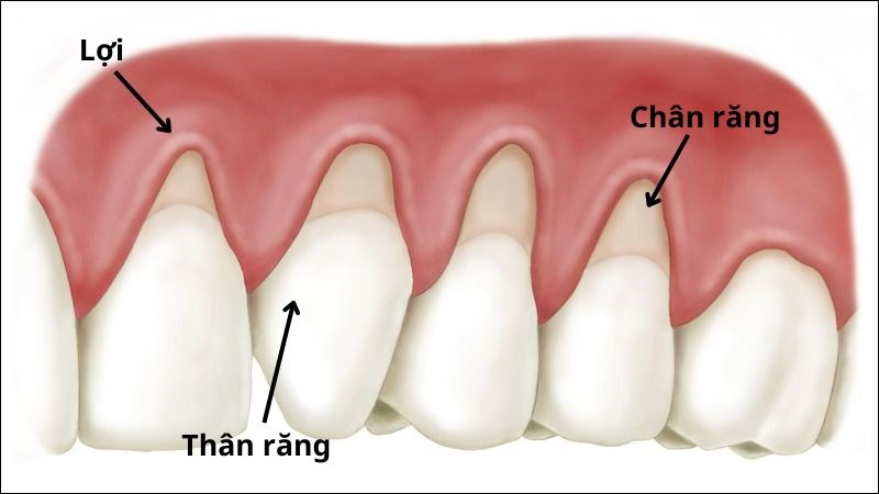 Tụt lợi là hiện tượng xung quanh chân răng bị mòn
