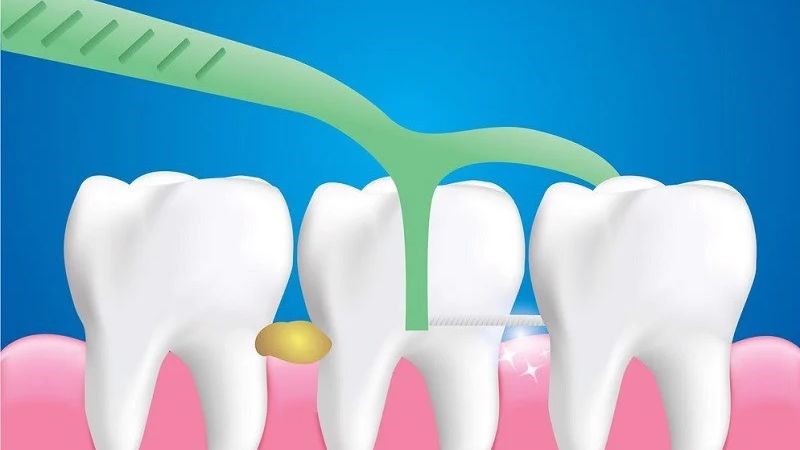 Sử dụng chỉ nha khoa sau bữa ăn để loại bỏ mảng bám