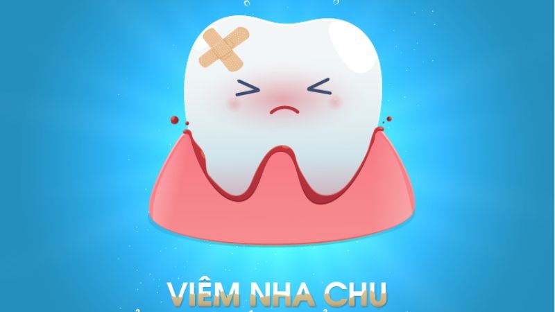 Bệnh nha chu là nguyên nhân chính gây tụt lợi