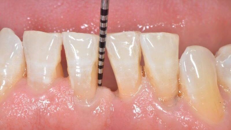 Dùng đầu dò nha chu để đo khoảng cách lợi và thân răng từ đó đưa ra chẩn đoán