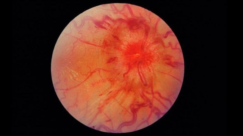 Hình ảnh phù gai thị khi soi đáy mắt
