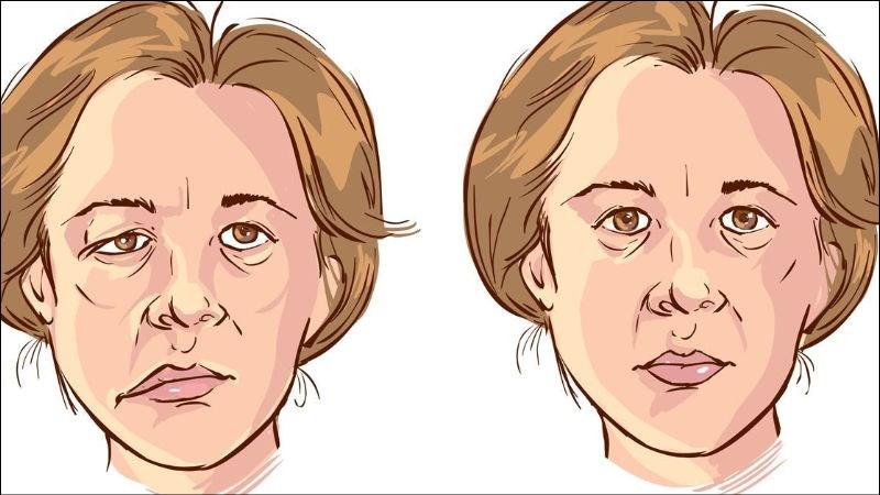 Phù gai thị tiến triển có thể gây liệt dây thần kinh số VII