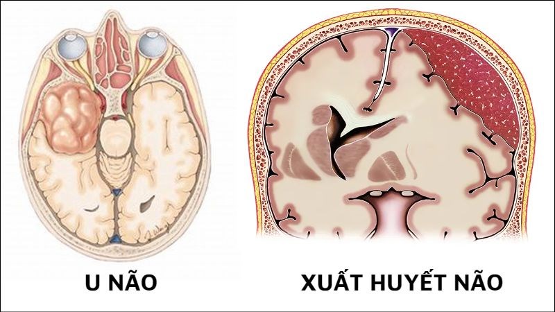 Phù gai thị gặp trong u não và xuất huyết não