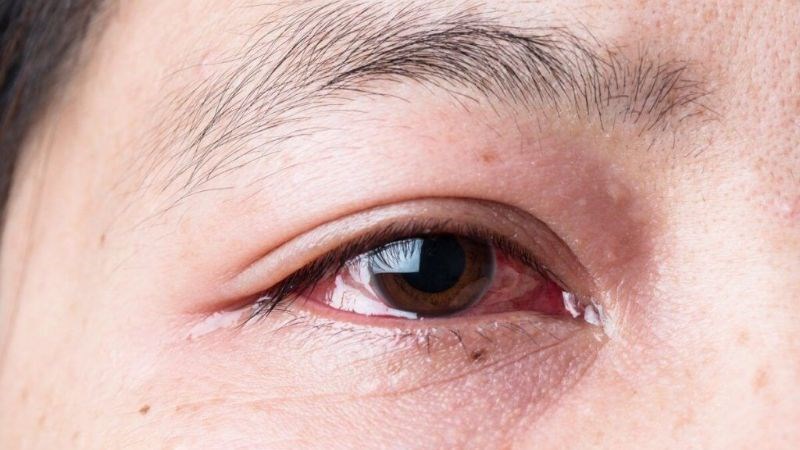 Cần phân biệt phù gai thị với các bệnh lý mắt khác