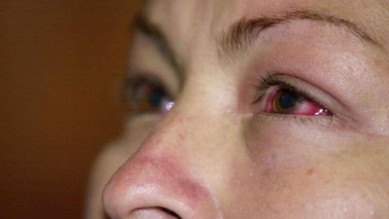 Viêm kết mạc là triệu chứng nghiêm trọng của bệnh