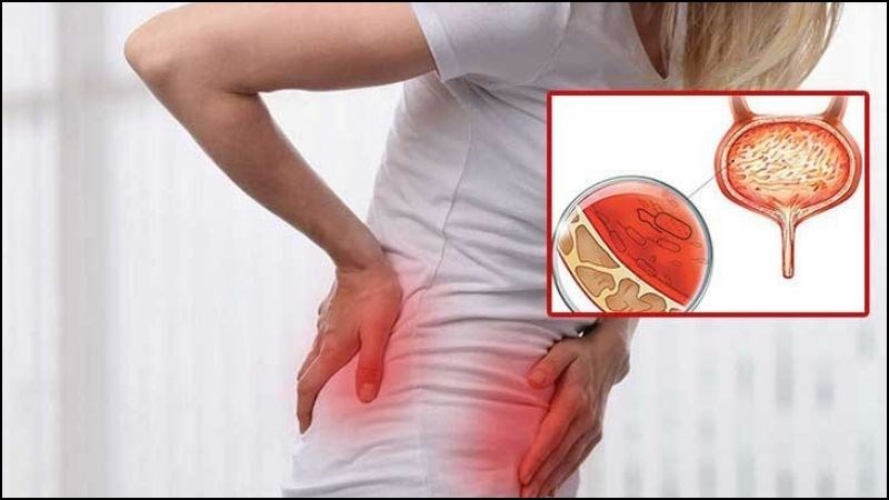 Sa bàng quang là một biến chứng của sa tử cung Sa bàng quang là một biến chứng của sa tử cung