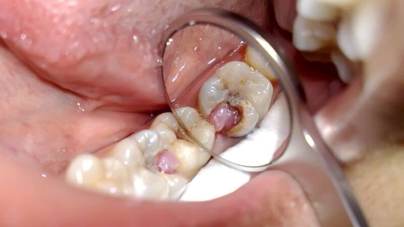 Sâu răng là nguyên nhân gây viêm tủy răng thường gặp Sâu răng là nguyên nhân gây viêm tủy răng thường gặp