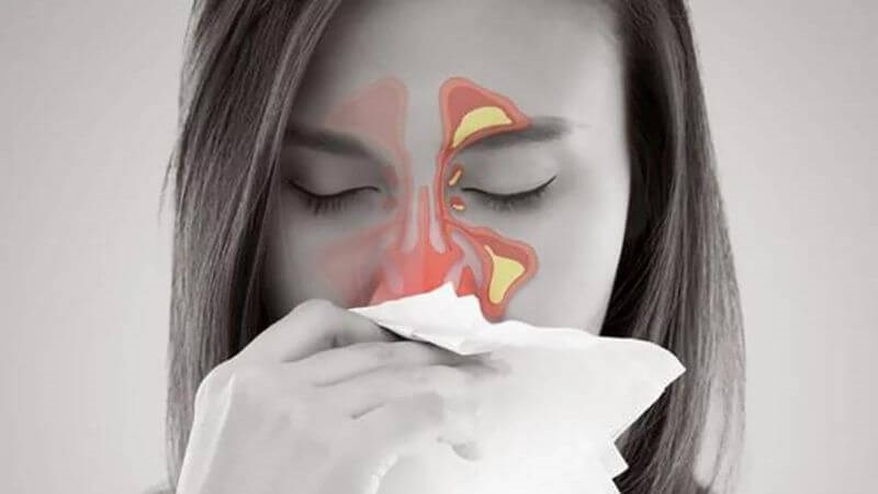 Viêm tủy răng hàm trên có thể dẫn đến biến chứng viêm xoang Viêm tủy răng hàm trên có thể dẫn đến biến chứng viêm xoang