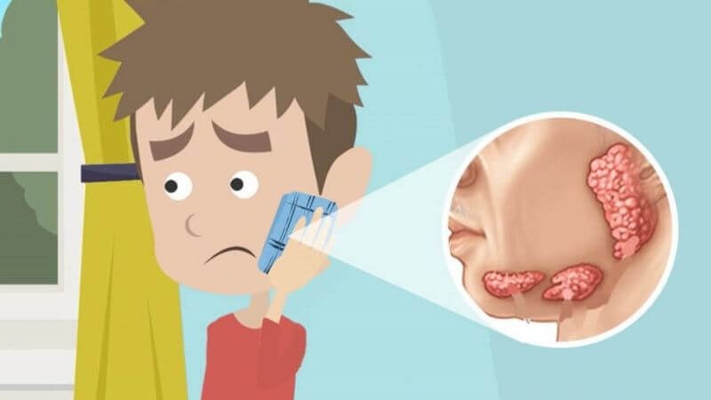 Viêm tuyến nước bọt là tình trạng một hay nhiều tuyến nước bọt bị viêm nhiễm do các tác nhân gây bệnh Viêm tuyến nước bọt là tình trạng một hay nhiều tuyến nước bọt bị viêm nhiễm do các tác nhân gây bệnh