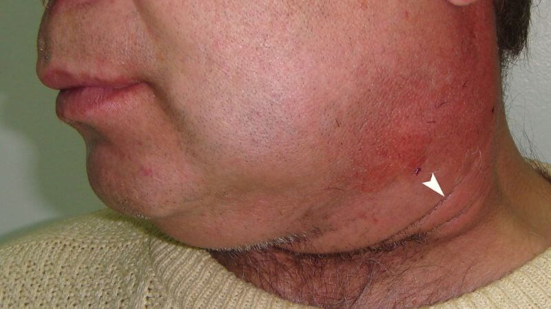 Sưng đỏ vùng góc hàm có thể là triệu chứng của viêm tuyến nước bọt Sưng đỏ vùng góc hàm có thể là triệu chứng của viêm tuyến nước bọt