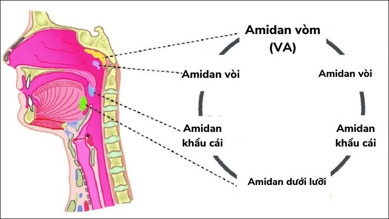 4. Chẩn đoán viêm VA