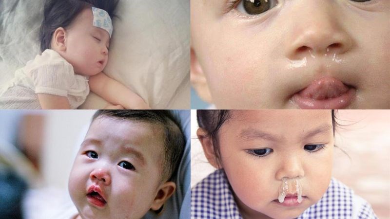 Các dấu hiệu viêm VA cấp tính