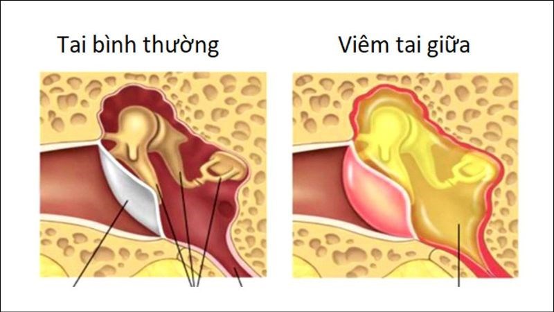 Viêm tai giữa là một biến chứng thường gặp của viêm VA
