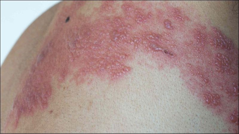 Mụn nước trong zona thần kinh tập trung thành đám, đau rát nhiều