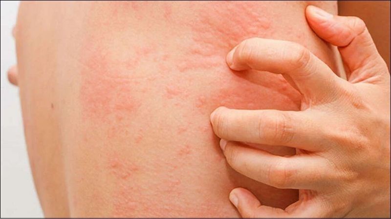 Ban dị ứng gây ngứa nhiều