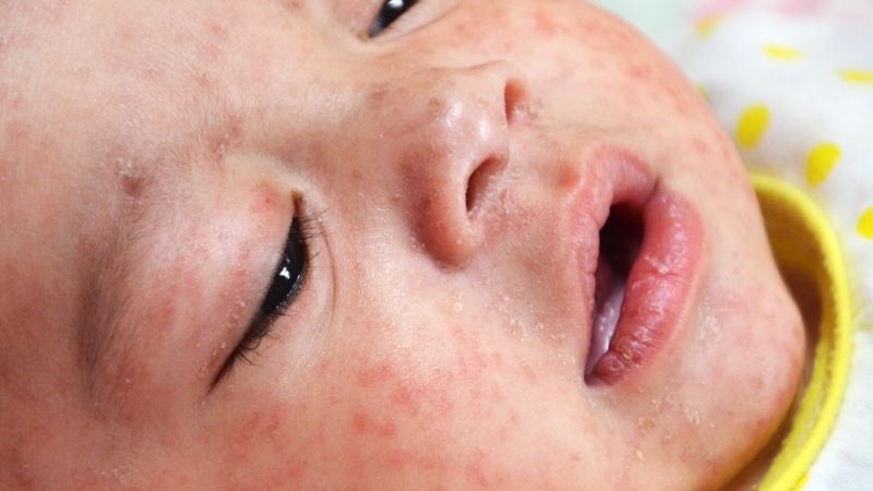 Bệnh sởi gây sốt cao kèm ban đỏ toàn thân
