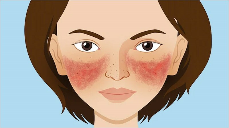 Lupus ban đỏ có ban hình cánh bướm đặc trưng ở mặt